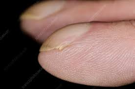 Image result for Clubbing nails feet