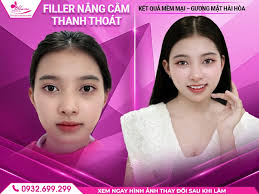 Mailisa Có Làm Đẹp Bằng Filler Không? Giải Đáp Chi Tiết