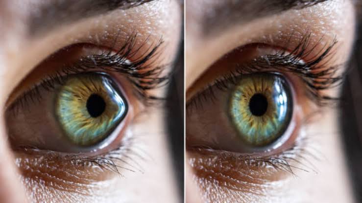 طرق علاج القرنية المخروطية بأحدث التقنيات العالمية دون ألم | Moatassem eye center