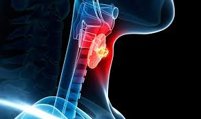These bacteria do not cause meningitis while in the throat and nose, but getting into the blood, cerebrospinal fluid and soft symptoms of meningitis, manifested most often, are headache, numbness (rigidity) of the neck muscles, fever, impaired. Cancer Symptoms Throat Tumour Signs Include Earache Express Co Uk