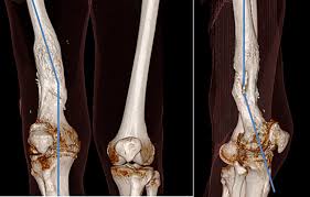 Most scoli spines have multiple curves and therefore have there you have a break down of the convex and concave portions of curves, the natural muscle development, and then what the fastest person in. Design And 3d Printing Customized Guides For Orthopaedic Surgery Lessons Learned Emerald Insight