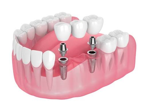 Crown, Veneers & Bridge care 3