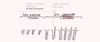 Laser seemed to be working. Does Hair Regrow After Electrolysis Hair Removal 2pass Clinic
