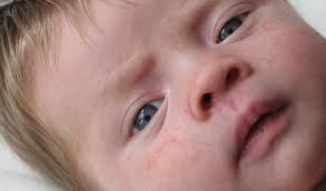 Image result for vyrážka u dětí