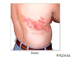 Image result for shingles