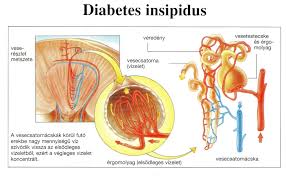 Hasil gambar untuk DIABETES INSIPIDUS