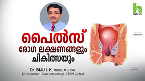Hemorrhoids are abnormally enlarged veins at or near the anus. à´ª àµ½à´¸ à´° à´— à´²à´• à´·à´£à´™ à´™à´³ à´š à´• à´¤ à´¸à´¯ How To Get Rid Of Piles Malayalam Health Tips Youtube