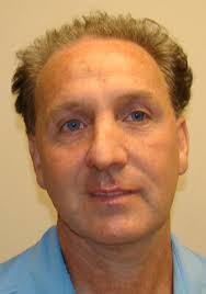 Best Rated Hair Transplant Doctor in Florida Lee Biggar