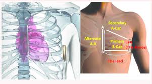 Image result for Internal Cardiac Defibrillator