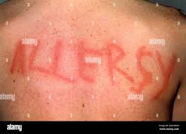 Image result for Dermatographism