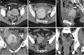 What Does Cul De Sac In Ultrasound Scan Signify? - Dr. Teena S Thomas -  Youtube