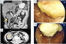 Image result for Adult Intussusception