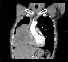 Ectopic Thymoma Retrospective Analysis Of Eight Cases With Clinical Features And Computed Tomography Findings Clinical Imaging