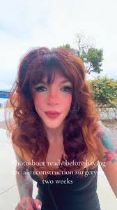 Treacher Collins Surgery Part 2