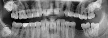 One of the most important requirements for a fast recovery is the formation of blood clots in the removal site. Wisdom Teeth Removal Cost Uk Recovery Time Pain Relief Faq Electric Teeth