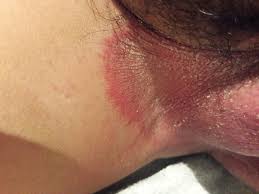Image result for penis mycosis symptoms