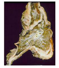 A series of mutations in the dna of the cell creates cancer. Gross Specimen Of Malignant Pleural Mesothelioma Presented Here Is An Download Scientific Diagram