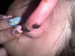 Had this top helix since August it's swollen and weeping advise please ?