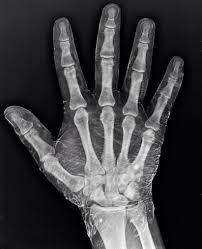 X Ray Of A Hand Dipped In Iodine Iodine Absorbs X Rays Revealing The Skin Around The Bones In 2020 Anatomy For Artists X Ray Hand Anatomy