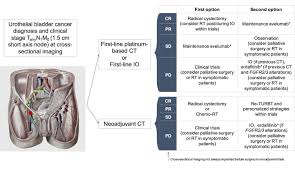 People with bladder cancer may experience the following symptoms or signs. Is It Time To Consider Eliminating Surgery From The Treatment Of Locally Advanced Bladder Cancer European Urology