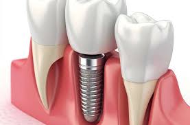 The Ultimate Guide to Dental Implants: Costs, Benefits, and More" |  Soothing Dental