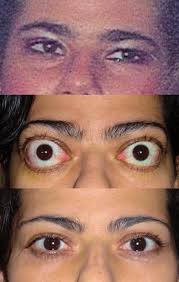 Thyroid orbitopathy