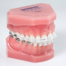 Black And White Braces For Teeth Qyresearchglobal Clear Braces Damon Clear Braces Damon Braces