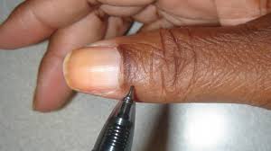 Image result for Elson Extensor Tendon Test