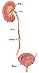 Having A Ureteral Stent