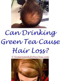Fibrosis, calcification and increased scalp tension are all part and parcel of male pattern hair loss. Pin On Hair Loss Stoppers