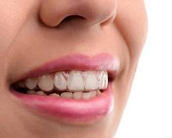 Invisalign aligners being worn