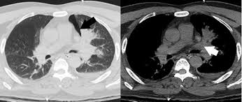 When bullous disease is present, a loculated pneumothorax may appear similar. Pneumothorax On Chest Ct Chest Ct Scan Showed Pneumothorax Black Download Scientific Diagram