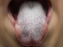 Despite its prevalence especially among younger women and children, there are few documented cases that doctors have been able to study in great detail, though there is some evidence that it's related to food allergies. Coronavirus Symptoms Lingual Papillitis Aphthous Stomatitis Glossitis And Sore Lips Are Express Co Uk