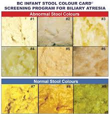 Bahaya air seni berwarna kuning pekat salah satunya adalah anemia. Dr Siti Sarah Aishah Suhaidi On Twitter Biliary Atresia Penyakit Di Mana Sistem Biliary Dan Salur Dlm Hati Tersumbat Sejak Lahir Lagi Tanda Penyakit Biliary Atresia Ialah Masalah Kuning Ataupun Jaundis Yang