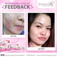 BEFORE and AFTER using Brilliant Rejuvenating Facial Set. 🔥✨ Grabe nawala yung mga alaga ni Ate sa pisnge nya. 😭 Kahit gaano kadami ang pimple mo sa mukha kayang kayang solusyunan ni