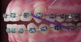 The whole process of removing braces, cleaning teeth, and fitting you for a retainer typically takes about an hour. How To Finish Your Braces Faster