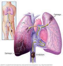 Pulmonary embolism (pe) is a blockage of an artery in the lungs by a substance that has moved from elsewhere in the body through the bloodstream (embolism). Embolia Pulmonar Sintomas Y Causas Mayo Clinic