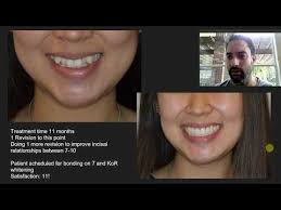 The Future of Aligners