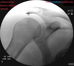 Image result for Subacromial Space Injection