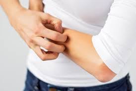 Resultado de imagen para dermatitis sintomas