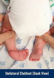 Image result for Clubfoot