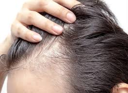 Lavaggi frequenti con shampoo non adeguati . Perdita Dei Capelli Archivi Trapiantofue