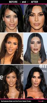 Kim was born 35 years ago, which means she must have experienced some symptoms of aging, such as fine lines, wrinkles, dark spots. Kim Kardashian Before And After Plastic Surgery Pictures 27 Pics