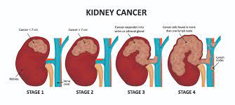 Today, the most common symptoms of kidney cancer are anemia, fatigue, weight loss, loss of appetite, and a fever. Kidney Cancer Parkway Cancer Centre Bangladesh