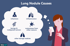 What Does Having A Nodule On The Lung Mean Idiopathic Pulmonary Fibrosis Lunges Pulmonary Fibrosis