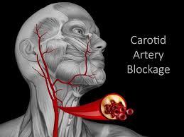 Image result for carotid artery