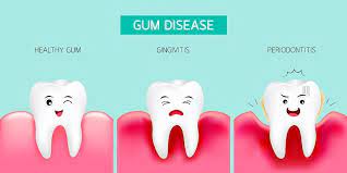 11 Home Remedies To Treat Gingivitis In Children Gingivitis Treatment Gingivitis Gum Disease