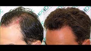 Deficiencies and supplements. dermatologic clinics 31.1 (2013): Ways To Regrow Lost Hair How To Apply Apple Cider Vinegar For Hair Loss Youtube