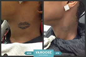 Tattoos have become an accepted part of society and an increasingly popular fashion accessory, but soon after getting a permanent piece of art drawn on your body, you may come to regret the decision. Tattoo Removal Before And After