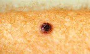 These hidden melanomas are more common in people with darker skin. Melanoma